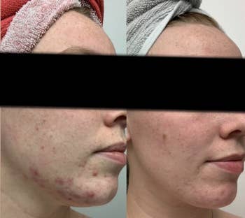 Reviewer showing face before and after using product