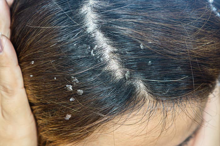 Tips To Treat A Dry Scalp And Dandruff In The Winter