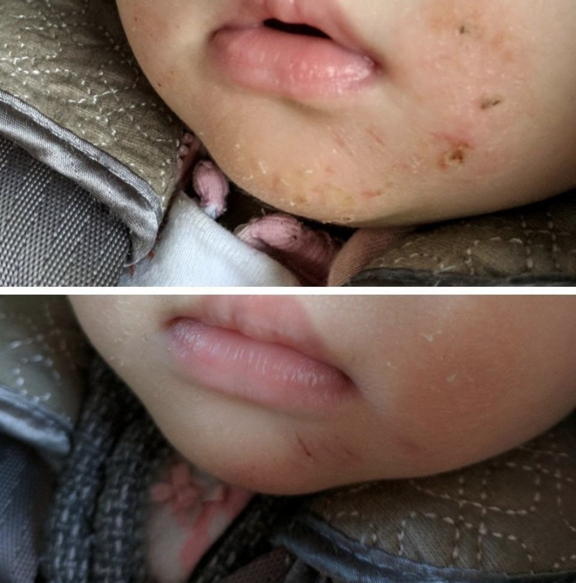 before and after showing baby&#x27;s skin noticeably improved around their mouth after using the cream