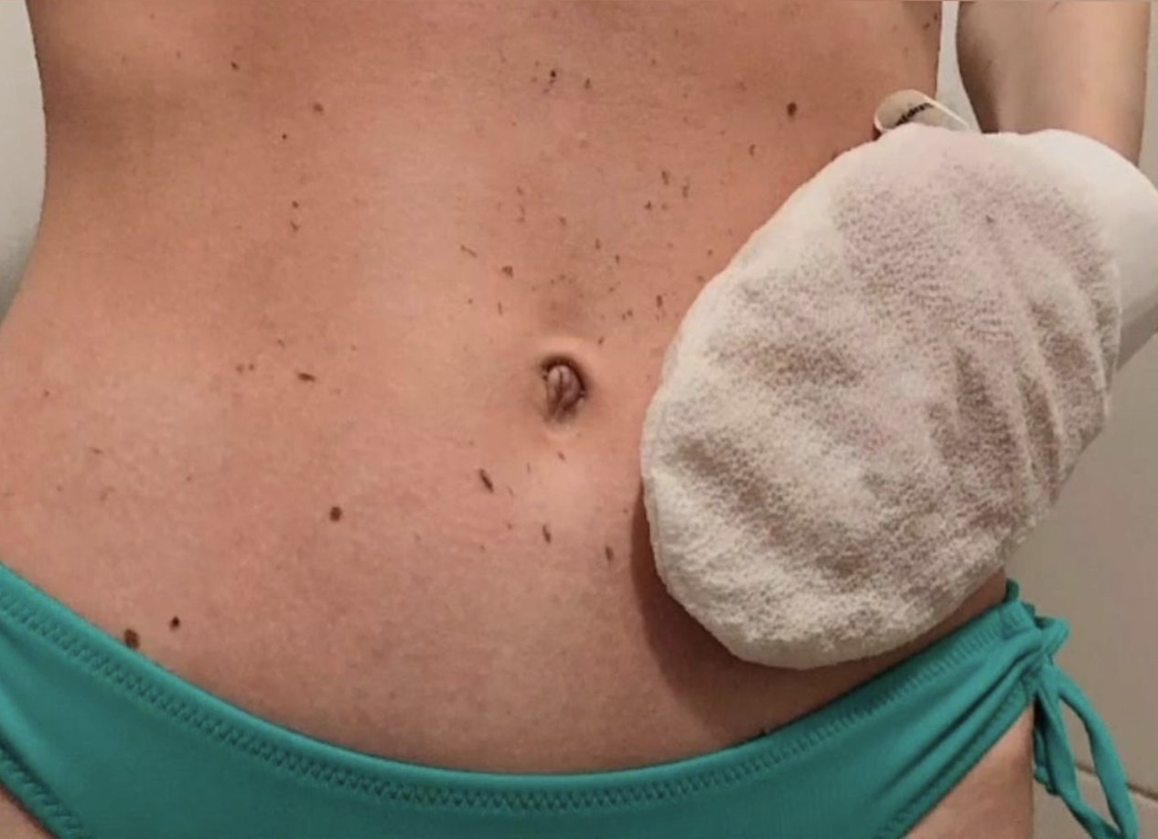 A woman using the exfoliating glove to scrub away dead skin on her stomach
