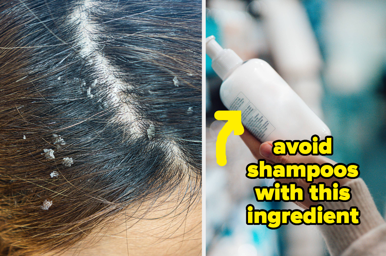 How To Treat Dry Scalp Causes Symptoms Home Remedies - vrogue.co