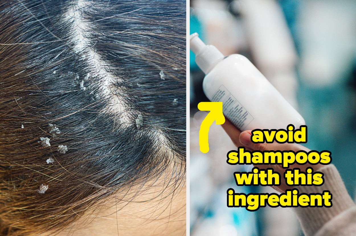 How To Treat Severe Dandruff Treatment For Dandruff Hair MTSIVC