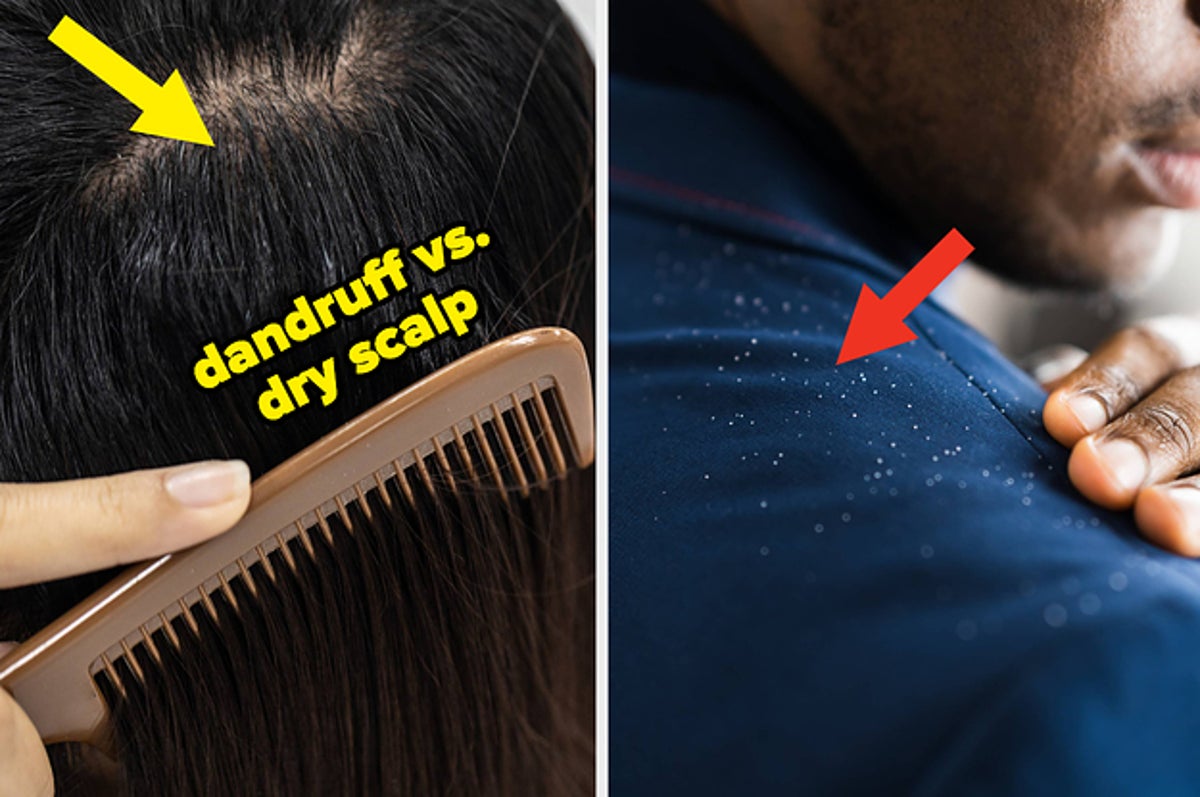 Tips To Treat A Dry Scalp And Dandruff In The Winter Tips To Treat A Dry Scalp And Dandruff In The Winter