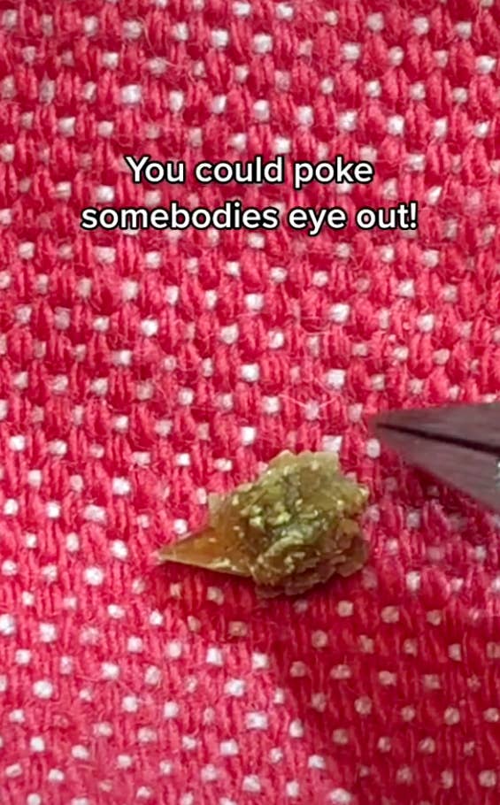 A closeup of the kidney stone with the caption &quot;You could poke somebodies eye out!&quot;