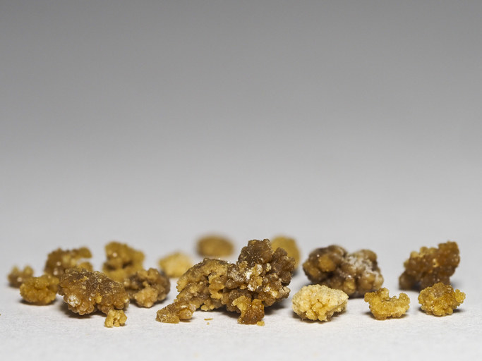 Several kidney stones of various sizes