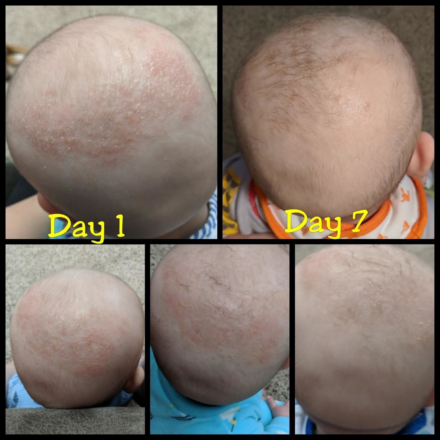 a series of images showing a baby's scalp eczema clearing up after seven days