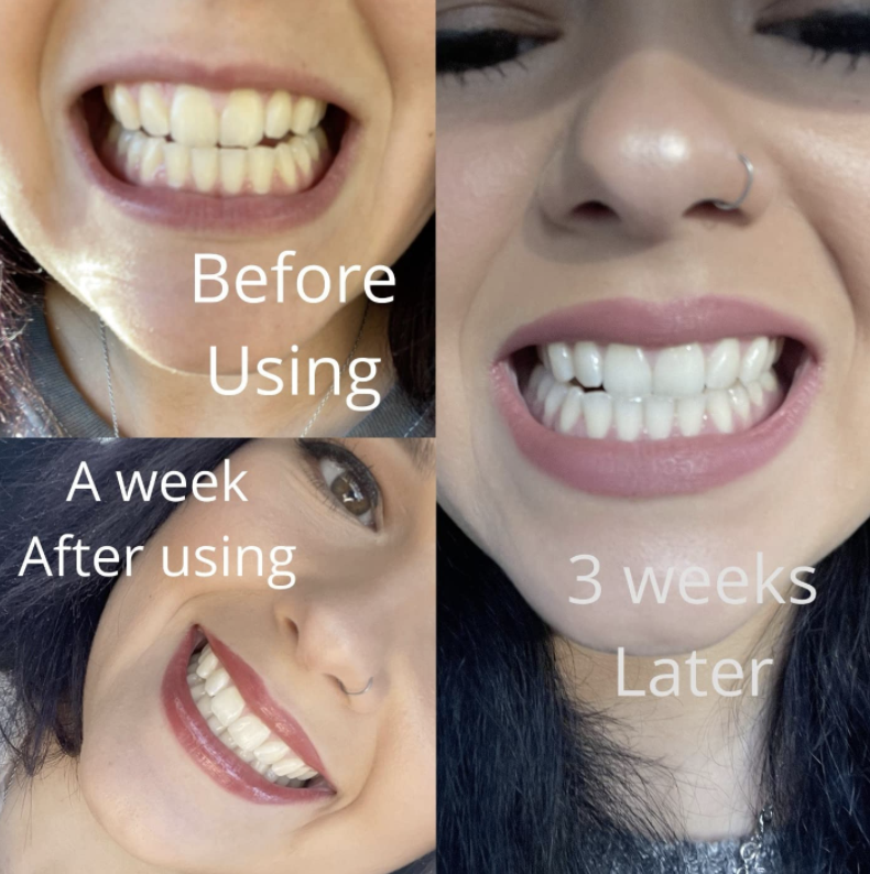 reviewer pic with light yellow teeth then very white teeth after using the pen for three weeks