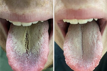 L: tongue with thick white film on it R: the same tongue looking cleaner