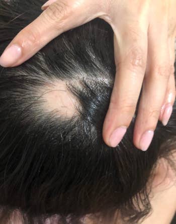 a reviewer's before photo showing a bald spot on their scalp