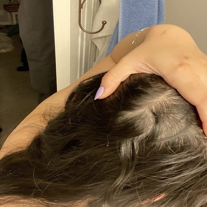 the same reviewer's after showing new hair growth in the previously bald spot