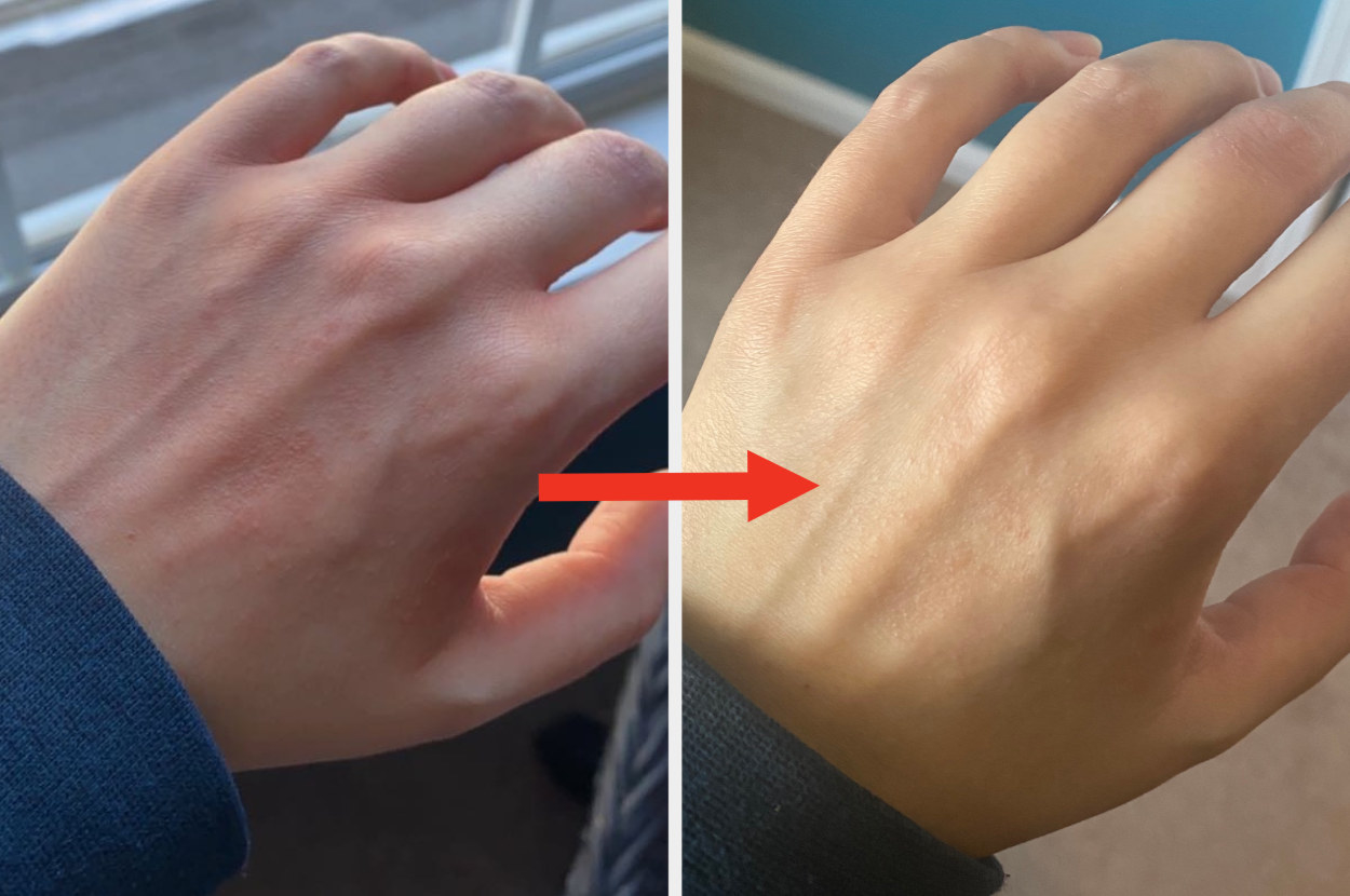 Left: An irritated and inflamed hand Right: A less irritated hand with an arrow connecting the two images