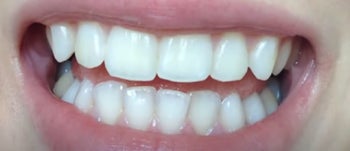 after image of reviewer's white teeth