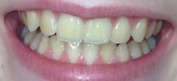 before image of reviewer's yellow teeth