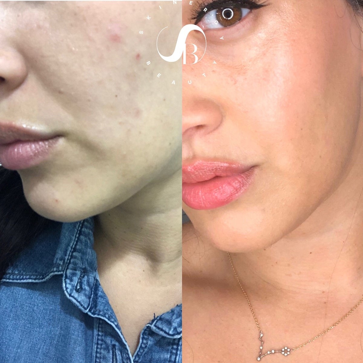 before and after images of a reviewer&#x27;s bumpy and acne-ridden skin becoming clear and even