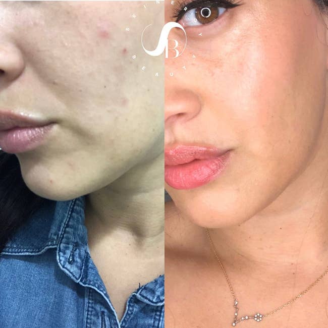 before and after images of a reviewer's bumpy and acne-ridden skin becoming clear and even