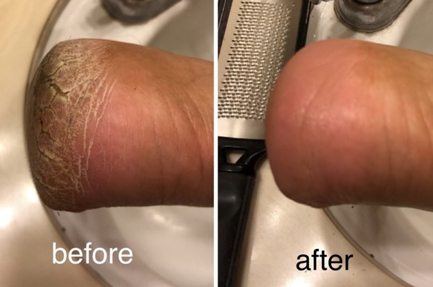 a before-and-after photo of a reviewer's cracked heel now looking soft and smooth