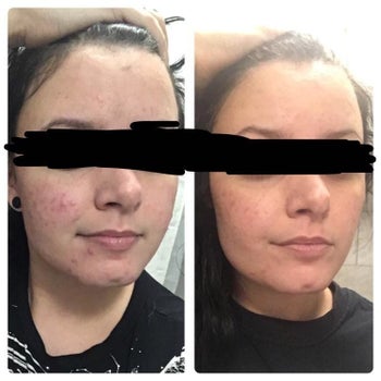reviewer showing before and after using the face wash with less redness and a smoother complexion after using