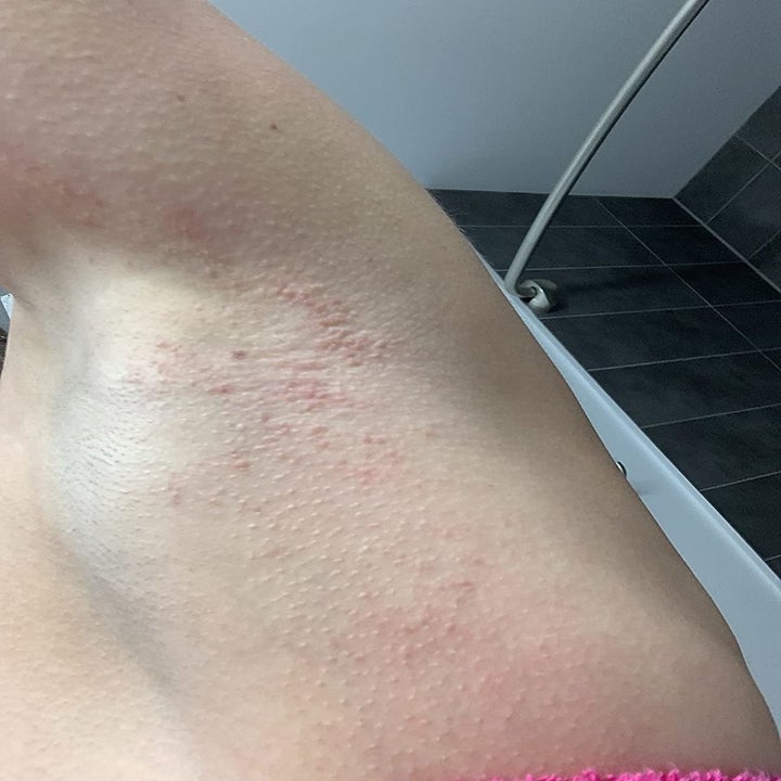 reviewer showing a rash/eczema around their armpit area
