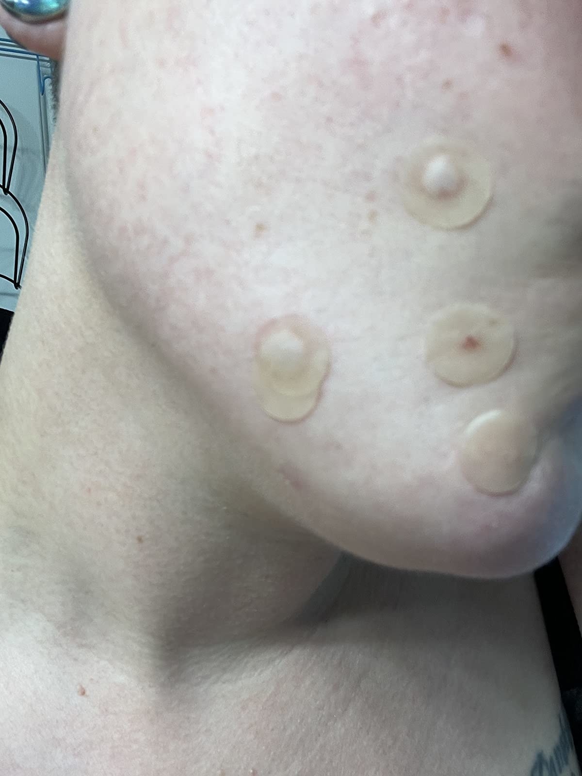 reviewer with pimple patches on their face and showing some of them filled with pus