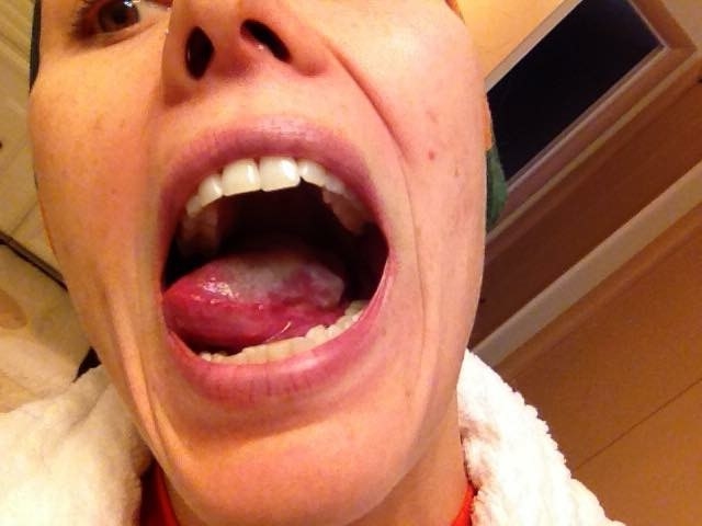 Cameron with her mouth open to show the tumour