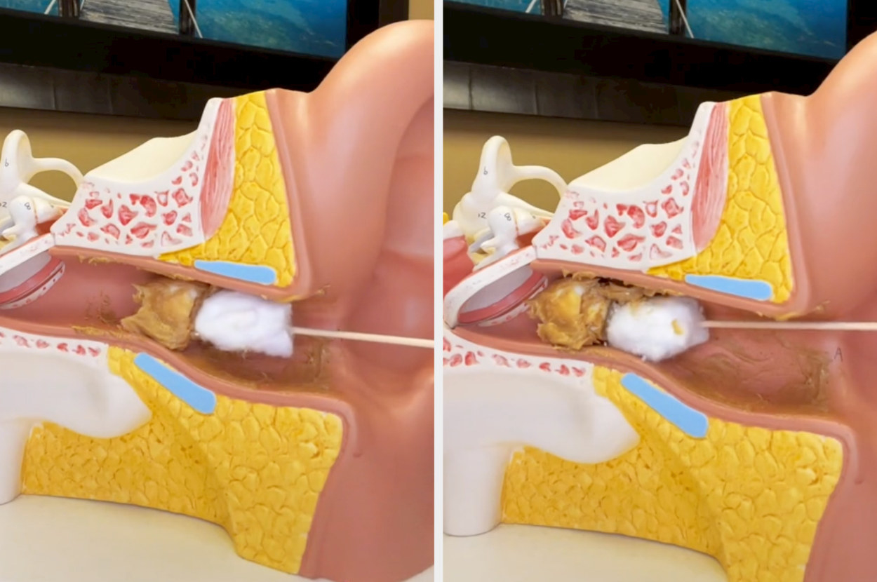 The diagram of the Q-Tip pushing the wax deeper into the ear