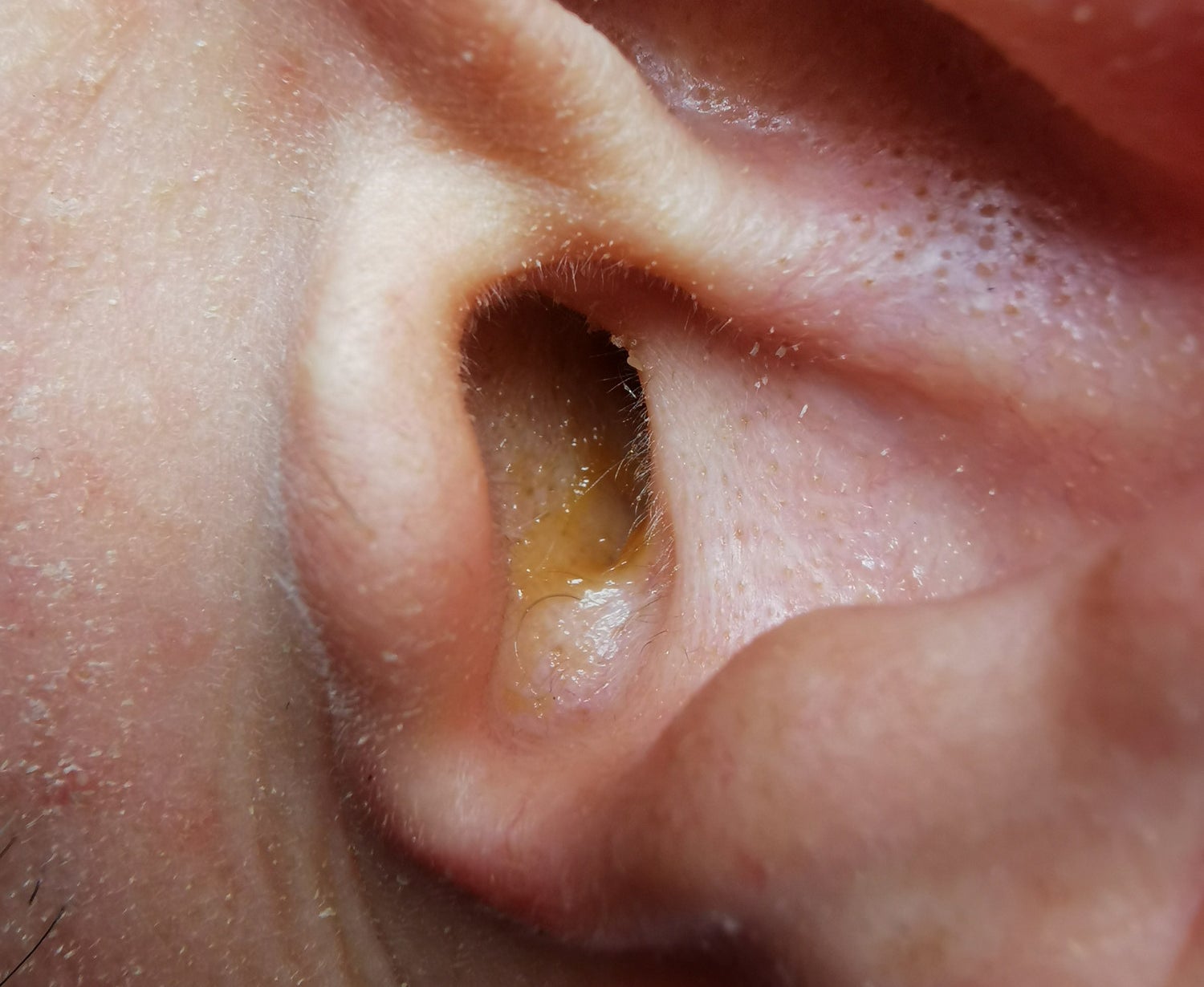 Ear wax in someone&#x27;s ear