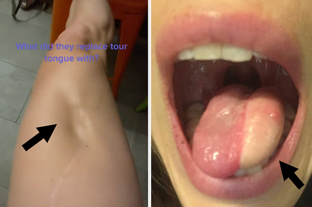 Doctors Had To Replace Half Of This Womans Tongue With Her Thigh Muscle, And The Results Are Mind Blowing