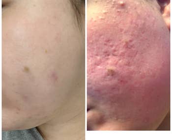 Reviewer before and after of their skin from using the serum