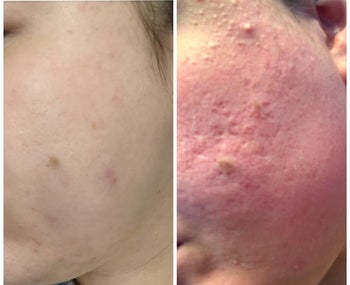 reviewer before and after of their skin from using the serum