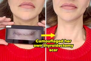 A before and after of Jody's thyroidectomy scar