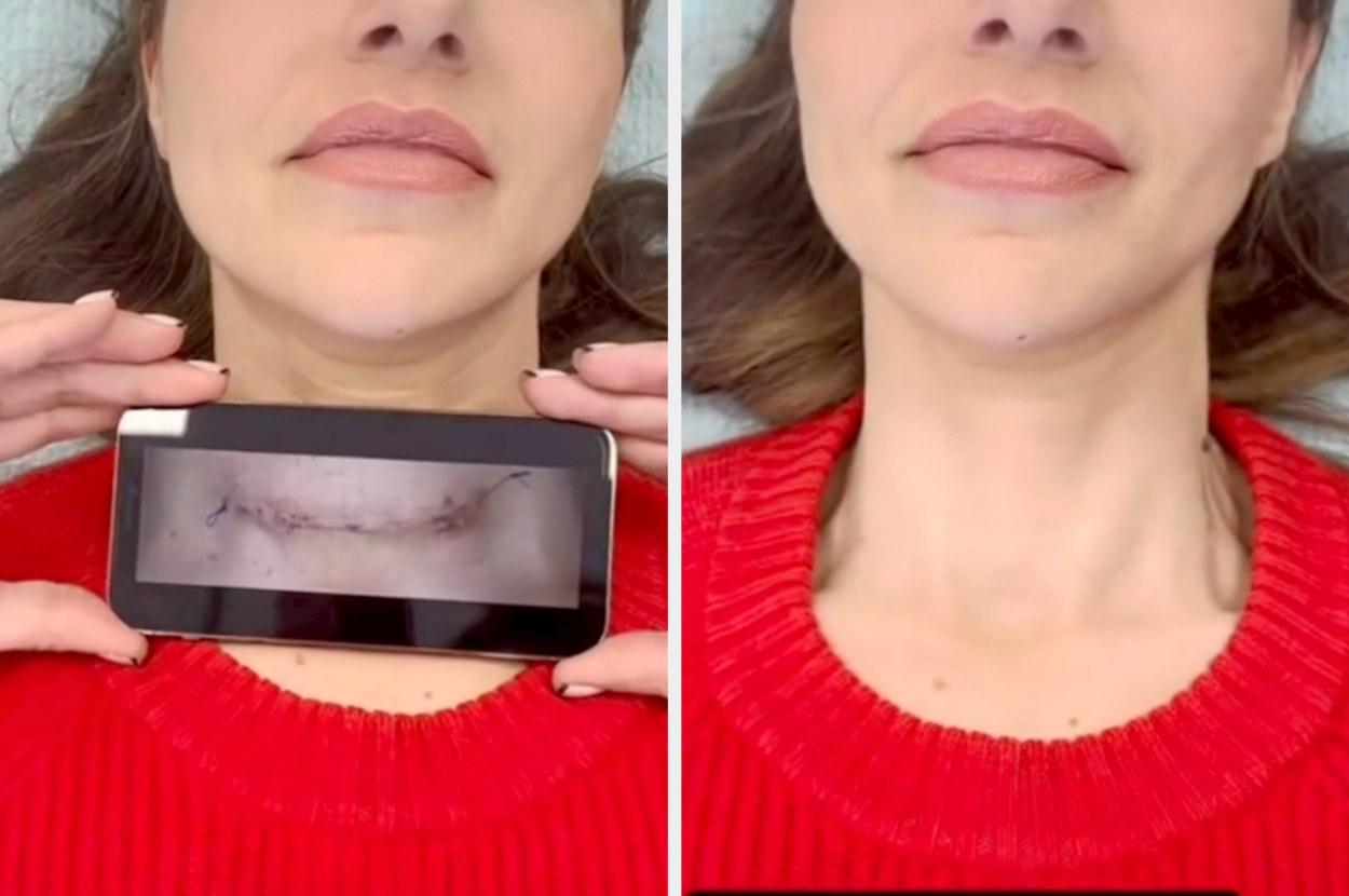 A before and after of Jody&#x27;s thyroidectomy scar