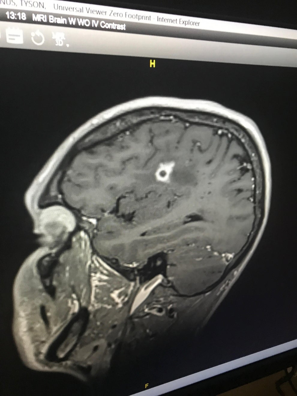 Black Mold Growing In Brain After Vacation