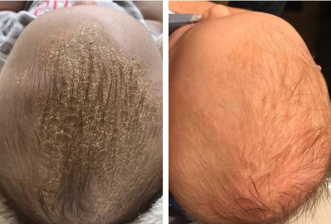 on the left, the top of a baby's head looking dry and flaky and, one the right, the same baby's head now clear of visible dryness