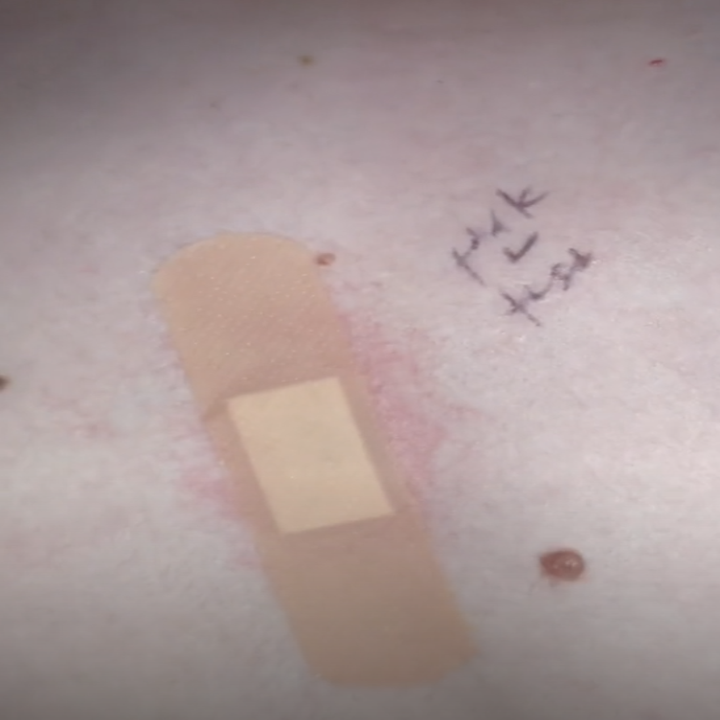 A bandaid over an area of Ryan's back that was biopsied