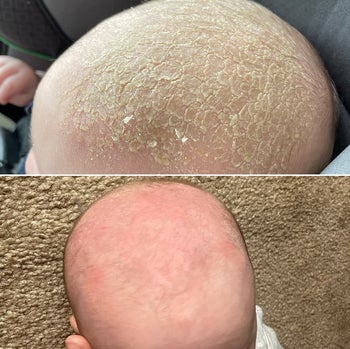 baby with super scaly scalp then the flakes removed