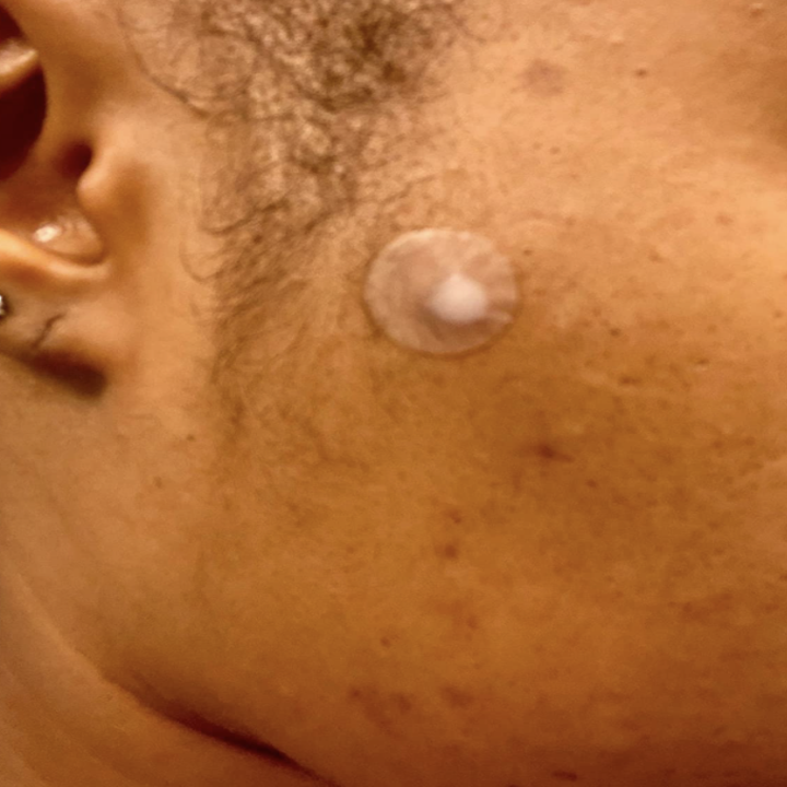 reviewer wearing pimple patch