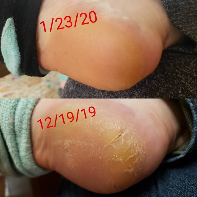 reviewer before and after photos of a cracked heel and a much smoother one, taken about a month apart