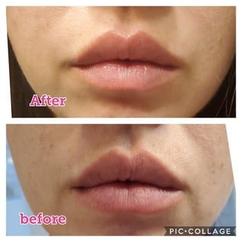 reviewer before and after photos showing dry lips and more hydrated looking lips after using the lip scrub