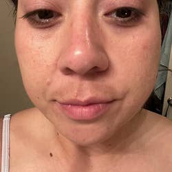 reviewer before photo showing discoloration above their lip due to sun damage