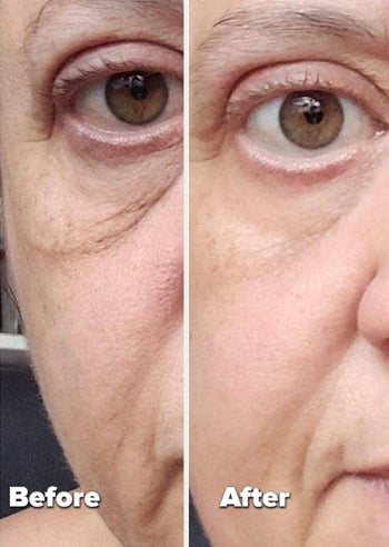 reviewer's before and after photo showing their eye bags disappearing over time