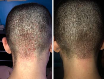 Reviewer before/after photo showing person's scalp red and irritated and then almost healed