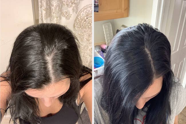 reviewer before and after photo showing their hairline noticeably fuller and thicker after using the shampoo