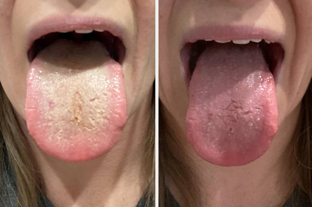 a dirty tongue before using the scraper / a clean tongue after using the scraper
