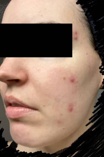 a reviewer with several blemishes along the side of their face