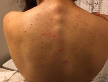 a reviewer's back covered in pimples