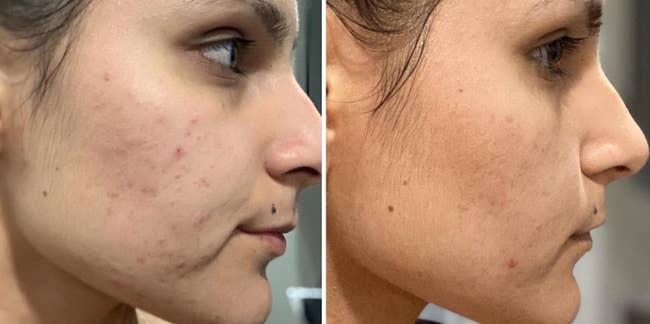 one the left, a reviewer with acne on their sheeks and, on the right, the same reviewer with their acne largely cleared