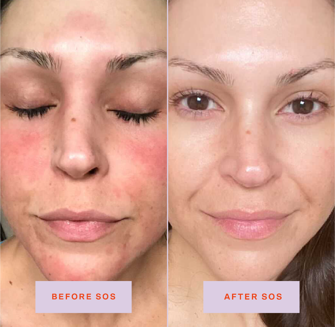 on the left, a reviewer with redness on their cheeks and chin labeled &quot;before sos&quot; and, on the left, the same reviewer with the redness reduced labeled &quot;after sos&quot;