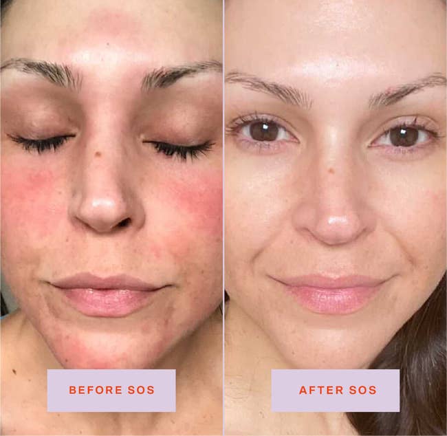 on the left, a reviewer with redness on their cheeks and chin labeled 