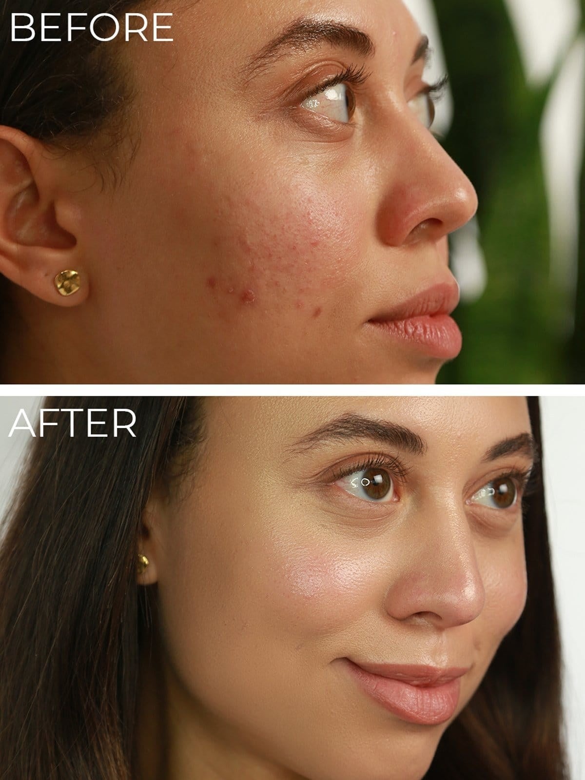 on the top, a reviewer with acne and redness on their cheeks and, on the bottom, the same reviewer with their skin now clear