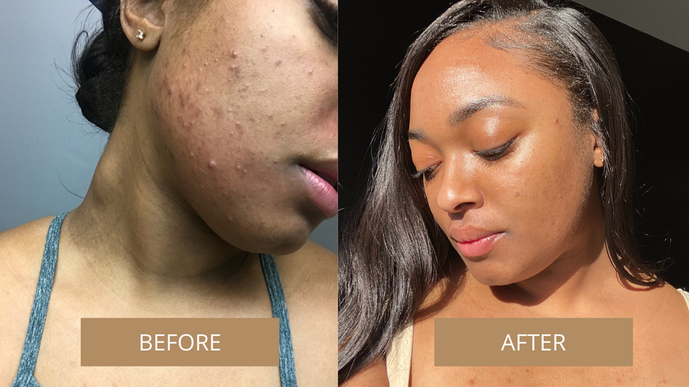 on the left, a reviewer with acne and dark spots on their chin labeled &quot;before&quot; and, on the right, the same reviewer with their skin cleared labeled &quot;after&quot;